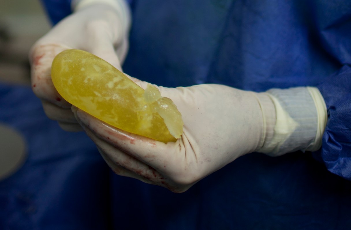 venezuelans-line-switch-pip-breast-implants