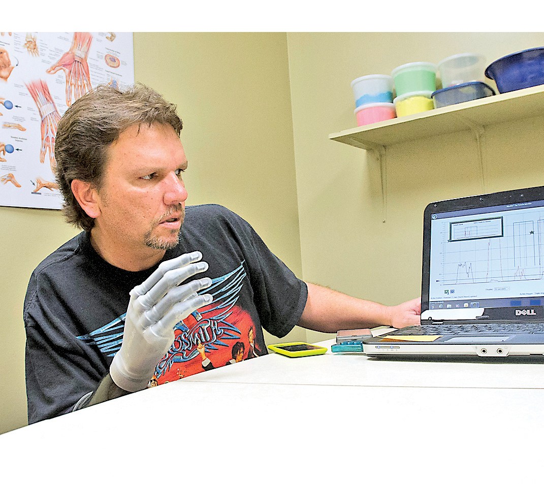 decatur-man-gets-bionic-hand-after-accident