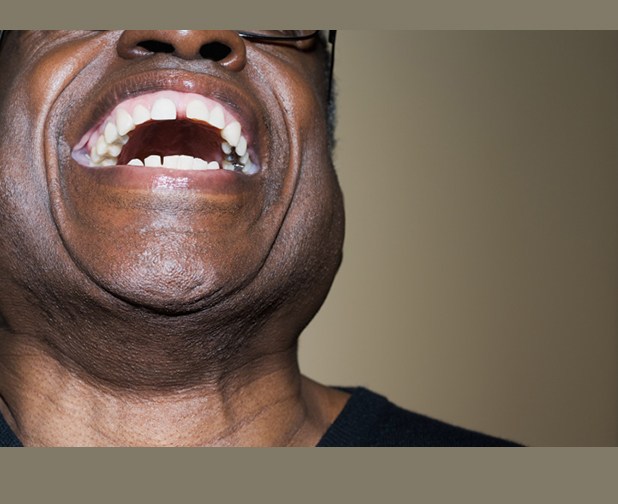 laugh-lines