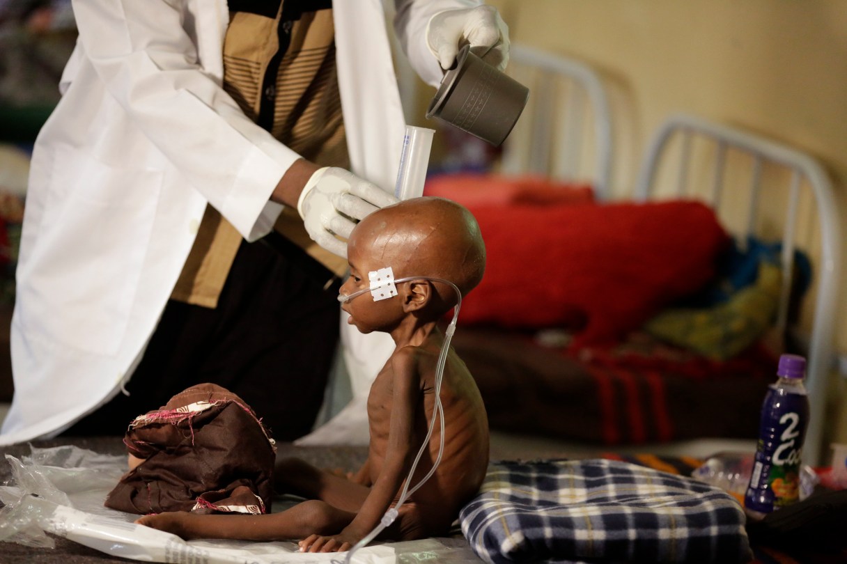 FILE- In this Monday Aug. 29, 2016 file photo, a malnourished child receives heath care at a feeding center run by Doctors Without Borders in Maiduguri Nigeria. The U.N. Security Council on Friday, March. 3, 2017 kicked off a visit to spotlight Africa's worst humanitarian crisis as millions face hunger amid the Boko Haram insurgency in Nigeria and the Lake Chad region. ( AP Photo/Sunday Alamba, File)